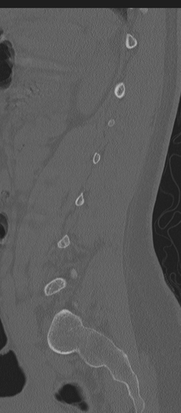 File:Normal lumbosacral CT (Radiopaedia 37923-39867 Sagittal bone window 31).png