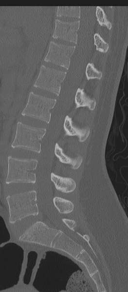 File:Normal lumbosacral CT (Radiopaedia 37923-39867 Sagittal bone window 50).png