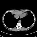 Normal multiphase CT liver (Radiopaedia 38026-39996 Axial non-contrast 4).jpg