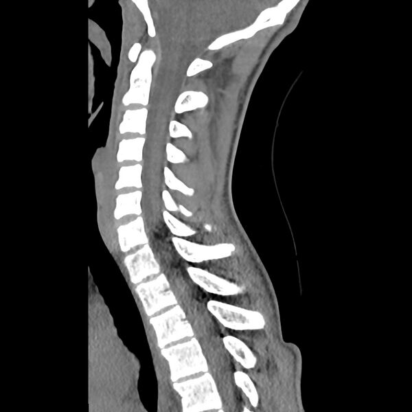 File:Normal trauma spine imaging (age 16) (Radiopaedia 45335-49358 C 18).jpg