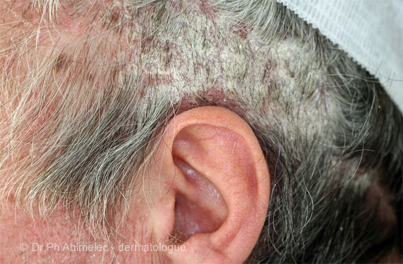 File:(DermNet NZ scaly-a-scalp-psoriasis).jpg