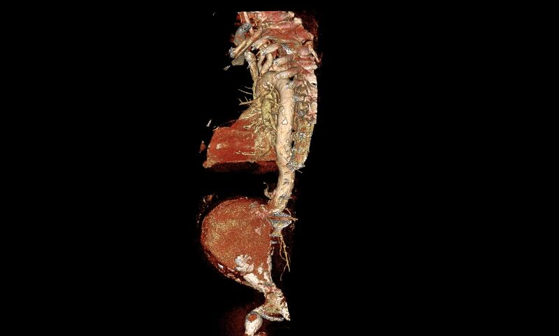 File:Abdominal aortic aneurysm- extremely large, ruptured (Radiopaedia 19882-19921 3D 11).jpg