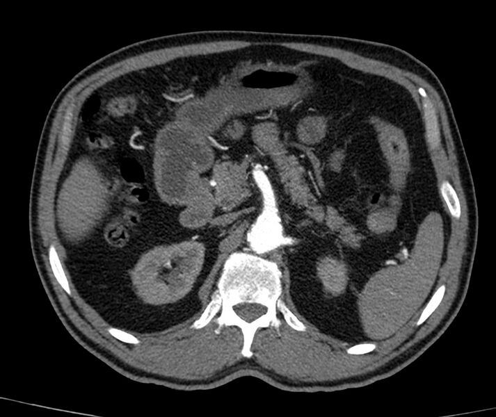 File:Abdominal aortic aneurysm (Radiopaedia 22421-22458 C+ arterial phase 21).jpg