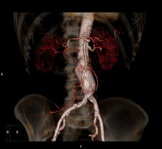 File:Abdominal aortic aneurysm (Radiopaedia 23703-23856 3D 2).jpg