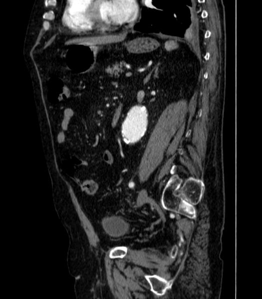 File:Abdominal aortic aneurysm (Radiopaedia 25855-26001 Sagittal C+ arterial phase 42).jpg