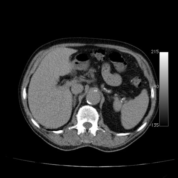 File:Abdominal aortic aneurysm (Radiopaedia 29248-29660 Axial non-contrast 17).jpg