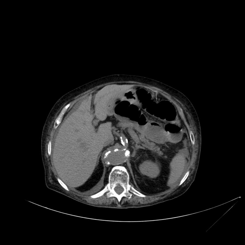 Abdominal aortic aneurysm - impending rupture (Radiopaedia 19233-19246 Axial non-contrast 36).jpg