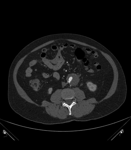 File:Abdominal aortic aneurysm with thrombus fissuration (Radiopaedia 46218-50618 Axial C+ arterial phase 22).jpg
