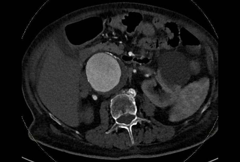 File:Abdominal aortic aneurysm with thrombus fissuration (Radiopaedia 73192-83919 Axial C+ arterial phase 61).jpg