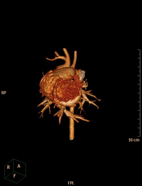 File:Aberrant left pulmonary artery (pulmonary sling) (Radiopaedia 42323-45435 3D reconstruction C+ CTPA 2).jpg