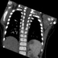 Aberrant left pulmonary artery (pulmonary sling) (Radiopaedia 42323-45435 Coronal C+ CTPA 7).jpg