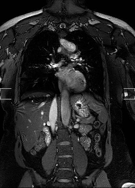 File:Aberrant right subclavian artery with background Takayasu arteritis (Radiopaedia 21423-21363 Coronal MRA 17).jpg