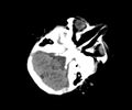 Abusive head trauma (Radiopaedia 70205-80252 Axial non-contrast 8).jpg