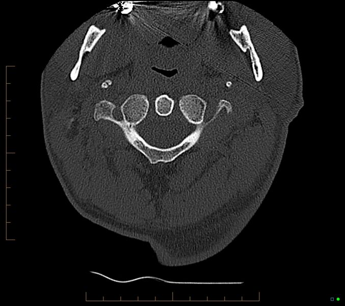 File:Accessory articulation of cervical transverse processes (Radiopaedia 82715-96933 Axial non-contrast 21).jpg