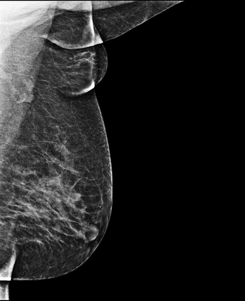 File:Accessory breast tissue (Radiopaedia 74571-85500 MLO 1).jpg