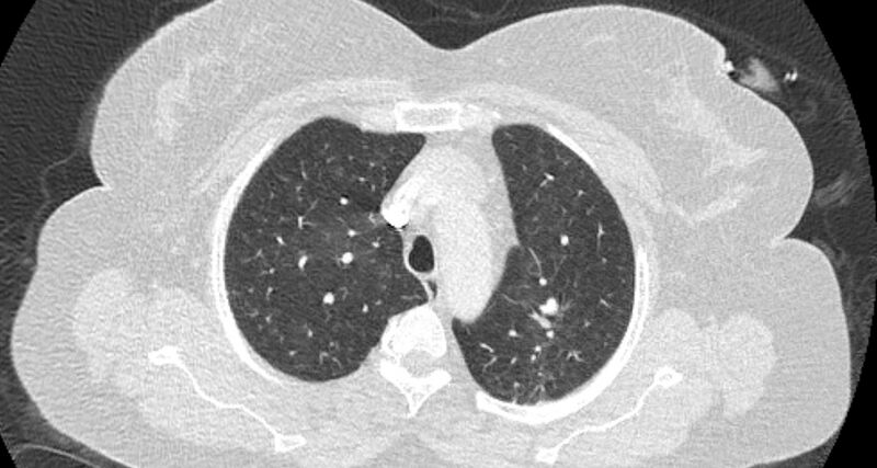 File:Accessory right inferior hepatic vein (Radiopaedia 65245-74259 Axial lung window 13).jpg