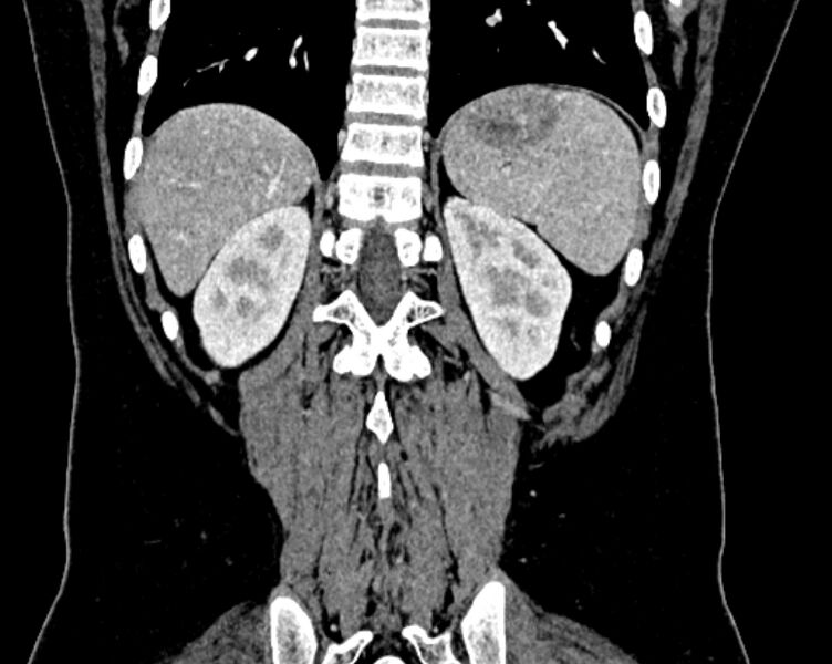 File:Accessory right inferior hepatic vein (Radiopaedia 75207-86305 Coronal C+ portal venous phase 63).jpg