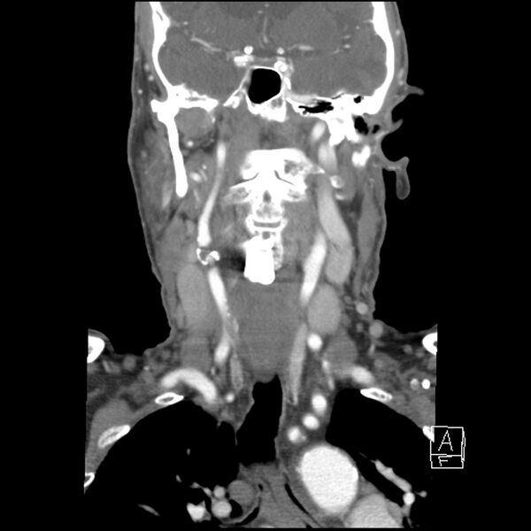 File:Acute ICA ischemic penumbra due to high-grade CCA stenosis (CT perfusion) (Radiopaedia 72038-82530 Coronal C+ arterial phase 20).jpg