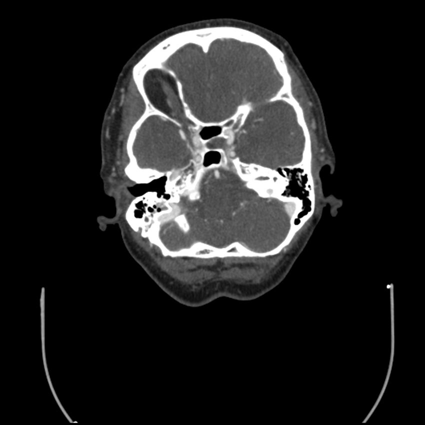 Acute M1 occlusion with ischemic penumbra (CT perfusion) (Radiopaedia 71897-82344 Axial C+ arterial phase thins 118).jpg