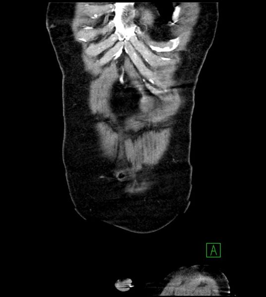 File:Acute arterial mesenteric ischemia (Radiopaedia 78238-90828 Coronal C+ portal venous phase 16).jpg