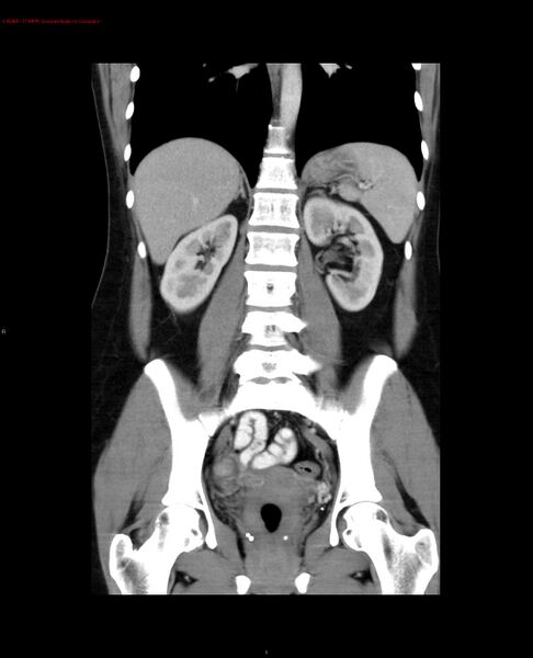File:Acute gastritis (Radiopaedia 21043-20975 Coronal C+ portal venous phase 7).jpg