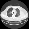 Acute heart failure (CT) (Radiopaedia 79835-93075 Axial lung window 15).png