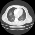 Acute heart failure (CT) (Radiopaedia 79835-93075 Axial lung window 30).png