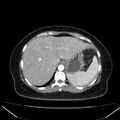 Acute pancreatitis - Balthazar C (Radiopaedia 26569-26714 Axial C+ arterial phase 17).jpg