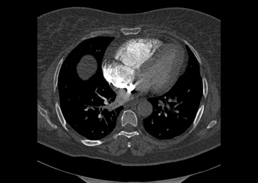 Acute pulmonary embolism (Radiopaedia 29938-30466 Axial C+ CTPA 131).jpg