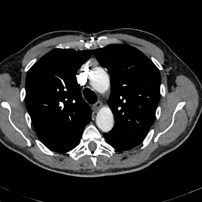 Acute pulmonary embolism (Radiopaedia 81677-95570 Axial C+ CTPA 12).jpg