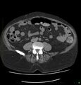 Acute renal failure post IV contrast injection- CT findings (Radiopaedia 47815-52557 Axial non-contrast 50).jpg