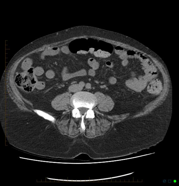 File:Acute renal failure post IV contrast injection- CT findings (Radiopaedia 47815-52557 Axial non-contrast 50).jpg