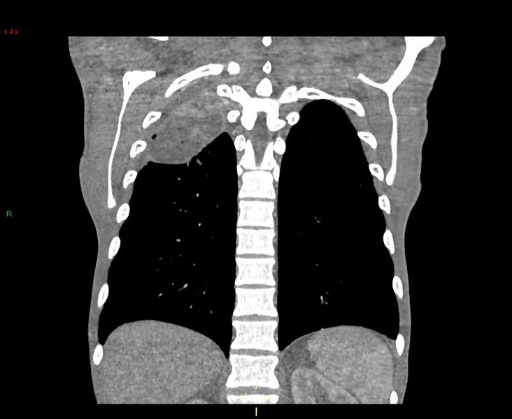 File:Acute right lung abscess (Radiopaedia 34806-36258 Coronal C+ arterial phase 11).jpg