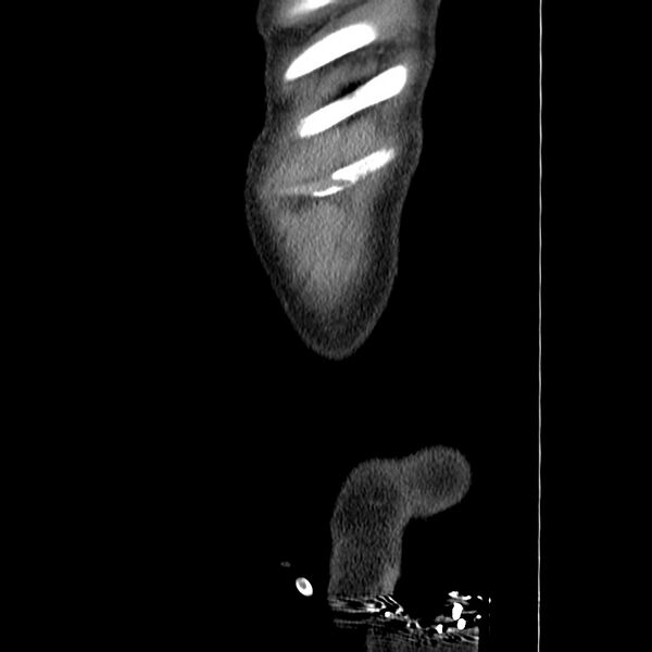File:Adenocarcinoma of colon with entero-colic fistula (Radiopaedia 22832-22852 Sagittal C+ portal venous phase 2).jpg