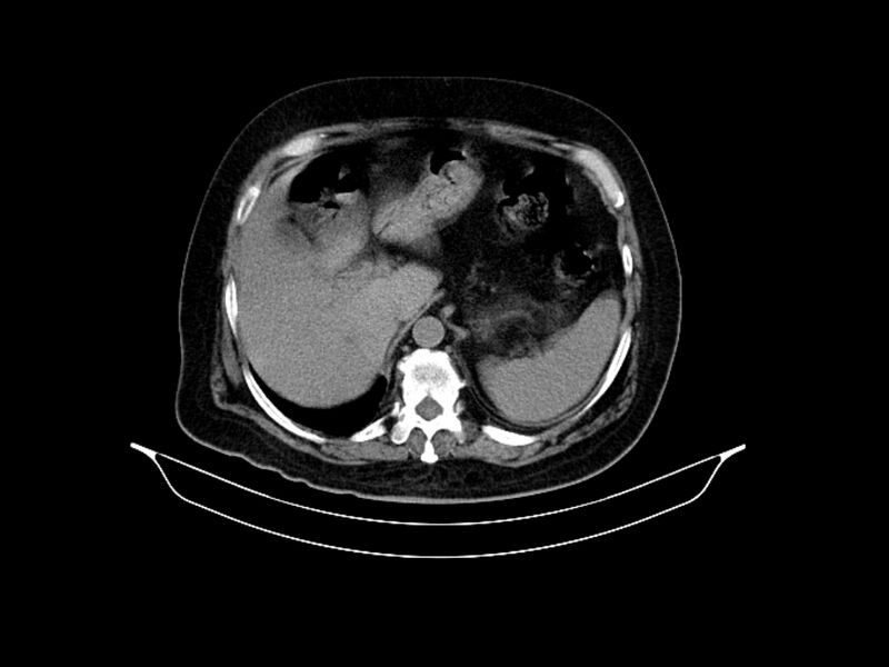 File:Adenocarcinoma of pancreas with hepatic metastasis (Radiopaedia 64332-73122 Axial non-contrast 27).jpg
