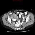 Adenocarcinoma of the colon (Radiopaedia 8191-9039 Axial renal excretory phase 50).jpg