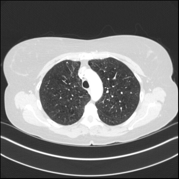 File:Adenocarcinoma of the lung (Radiopaedia 44205-47803 Axial lung window 29).jpg