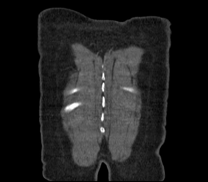 File:Adenocarcinoma of the lung (Radiopaedia 44205-47803 Coronal C+ portal venous phase 97).jpg