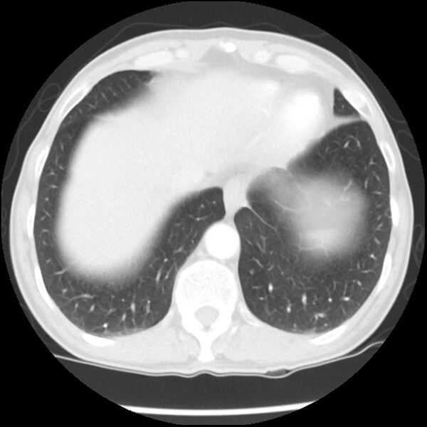 File:Adenocarcinoma of the lung - micropapillary predominant (Radiopaedia 42446-45563 Axial lung window 61).jpg