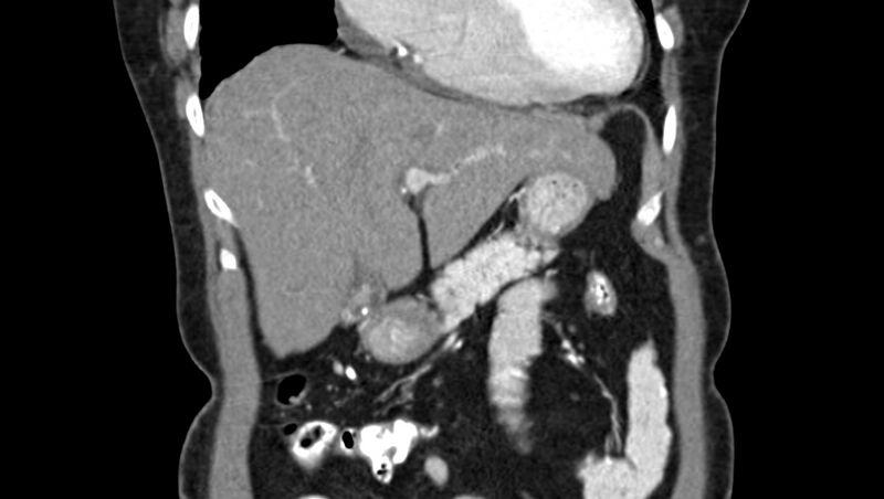 File:Adenomyomatosis of the gallbladder (Radiopaedia 12142-12483 Coronal C+ arterial phase 11).jpg