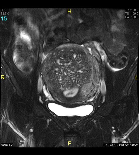 File:Adenomyosis (Radiopaedia 43504-46889 Coronal T2 fat sat 15).jpg