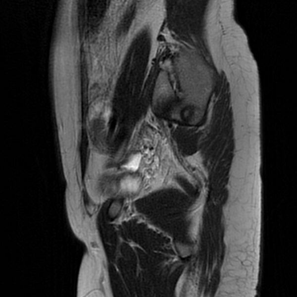 File:Adenomyosis within a septate uterus (Radiopaedia 69963-79981 Sagittal T2 25).jpg