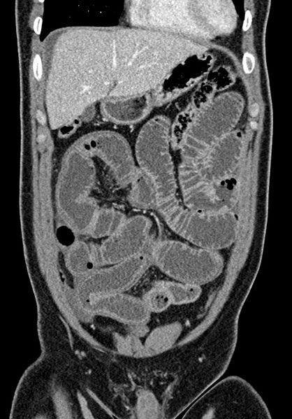 File:Adhesional small bowel obstruction (Radiopaedia 58900-66131 Coronal C+ portal venous phase 93).jpg