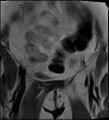 Adnexal multilocular cyst (O-RADS US 3- O-RADS MRI 3) (Radiopaedia 87426-103754 Coronal 6).jpg