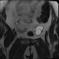 Adnexal multilocular cyst (O-RADS US 3- O-RADS MRI 3) (Radiopaedia 87426-103754 Coronal T2 8).jpg