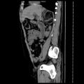 Adrenal myelolipoma (Radiopaedia 41843-44834 Sagittal non-contrast 16).jpg