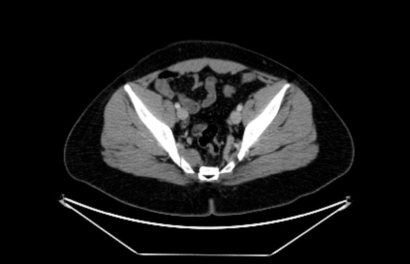 File:Adrenocortical carcinoma (Radiopaedia 80134-93438 Axial C+ portal venous phase 110).jpg
