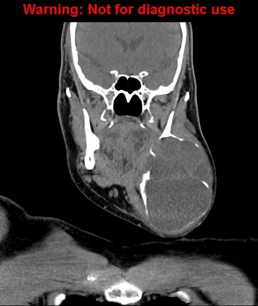 File:Ameloblastoma (Radiopaedia 33126-34164 D 31).jpg