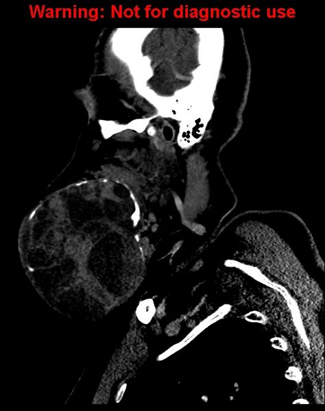 File:Ameloblastoma (Radiopaedia 33126-34164 F 15).jpg