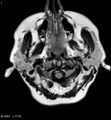 Amyotrophic lateral sclerosis (Radiopaedia 5373-7134 Axial FLAIR 1).jpg